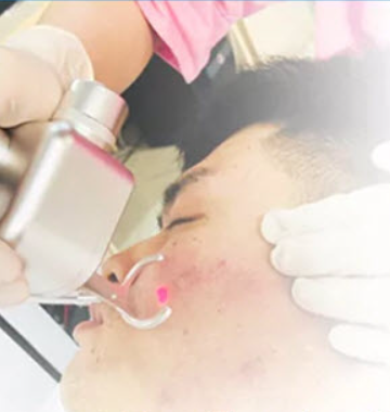 ¿Qué Es una Máquina Láser CO₂ Fraccionado y Sus Usos?